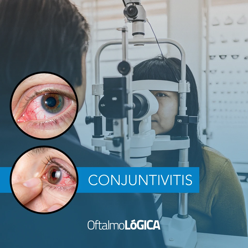 Tratamiento de la conjuntivitis @ Oftalmológica - Centro Oftalmológico Integral, Santo Domingo, República Dominicana