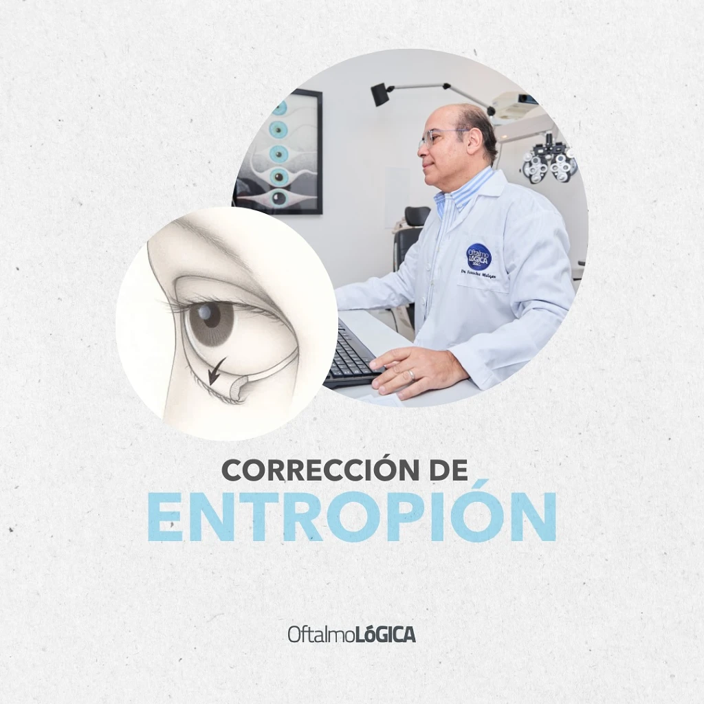 Corrección de Entropión | Oftalmológica, Centro Oftalmológico Integral, Santo Domingo, República Dominicana